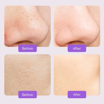 YOU Ultraschallreinigungsgerät, Gesichtsreiniger, Mitesserentferner Porenreinigung Akne-Peeling, Mikrodermabrasion, Hautpflege, Massage, aufladbar (6)